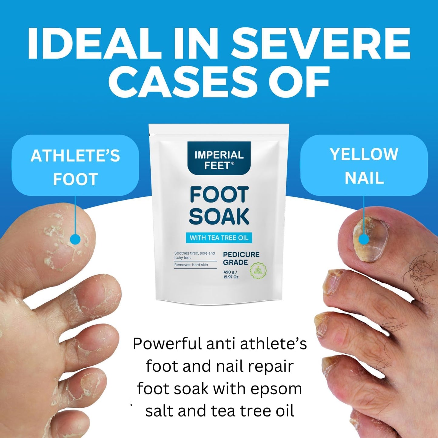 Epsom Salt Foot Soak W Tea Tree for Foot Bath (PEDICURE GRADE) - Toenail Repair, and Fungus Athletes Foot, Softens Calluses, Tired Feet, Nail Discoloration Foot Soak Salts, Smelly Foot Therapy16Oz